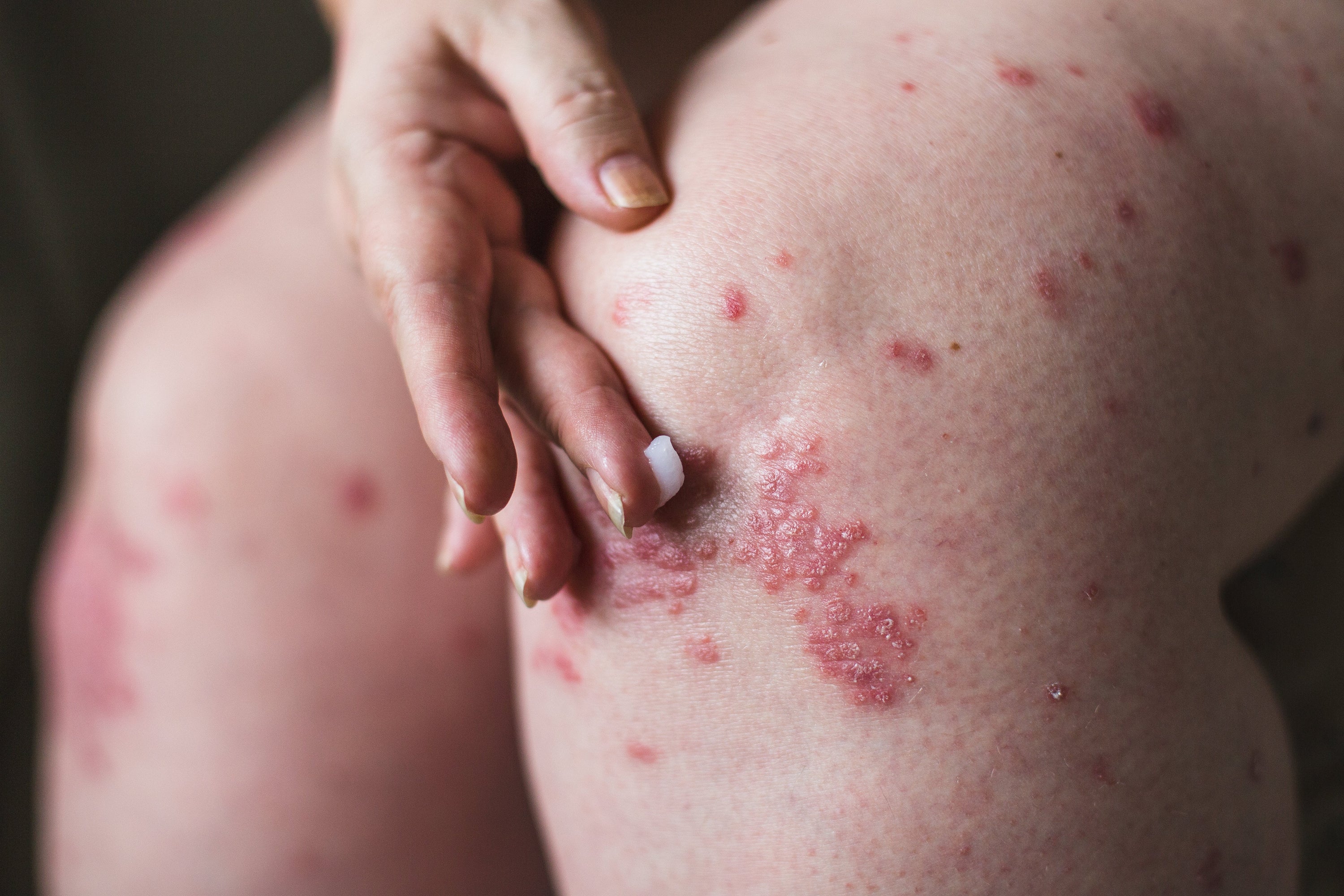 Eczema Treatments: Natural, Non-Steroidal, and Long-Term Solutions