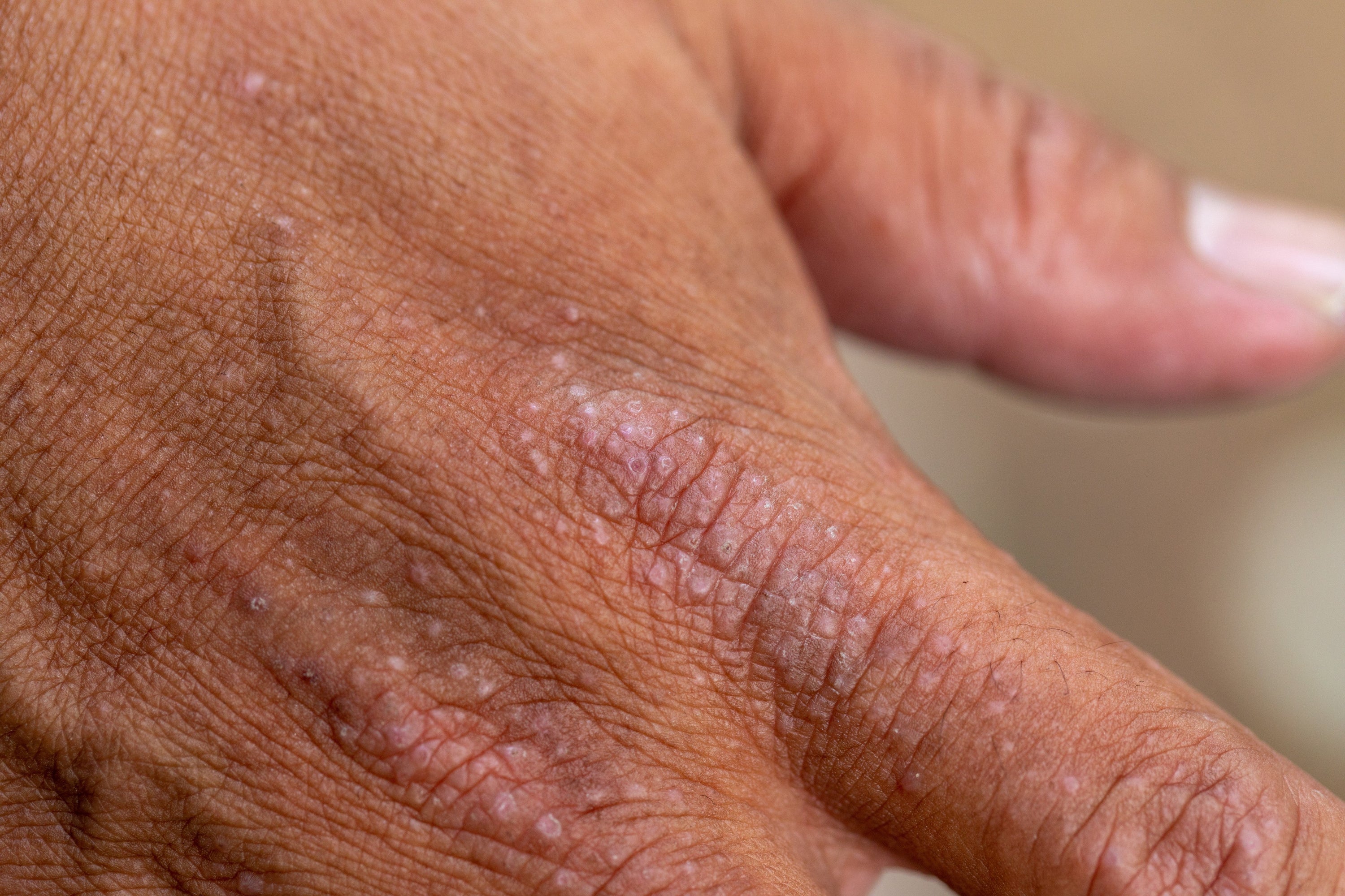 Atopic Dermatitis: Causes, Symptoms, and the Best Treatment Creams