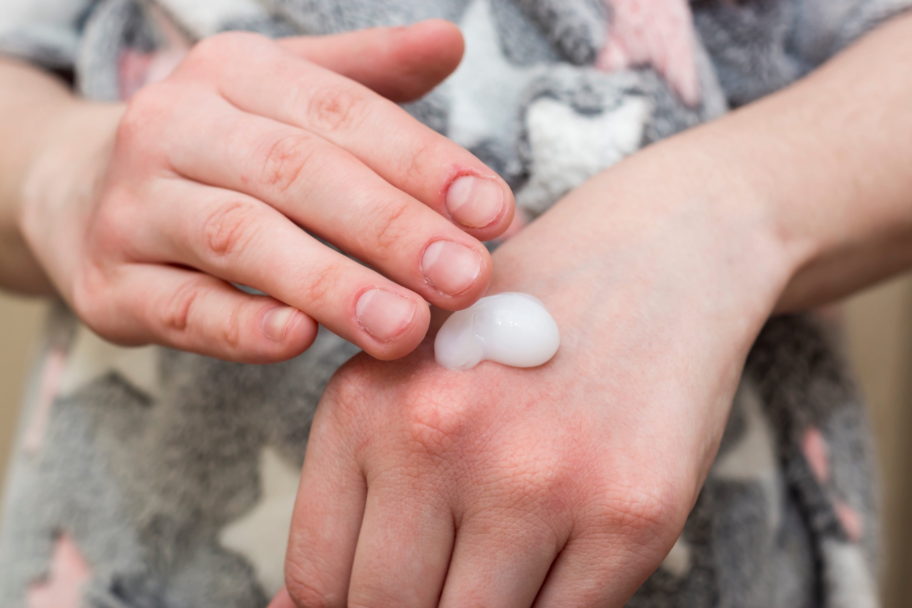 Best Cooling Cream for Eczema: How It Helps Relieve Itching and Inflammation