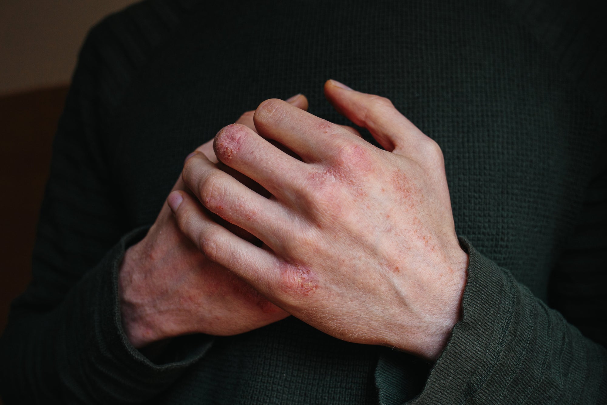 man's hands with eczema