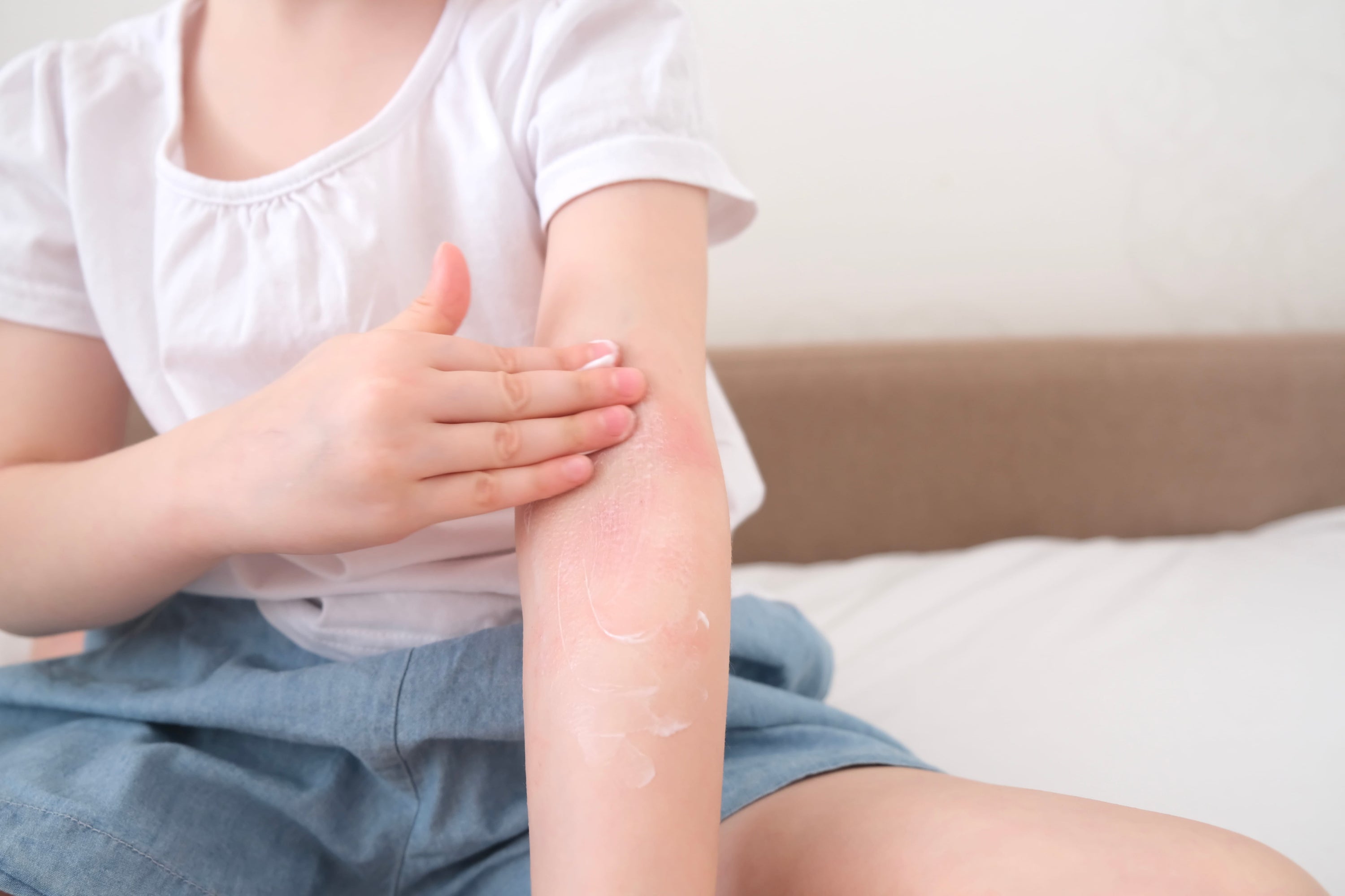 Cooling vs Moisturising Eczema Cream: Which One Is Better for Flare-Ups?