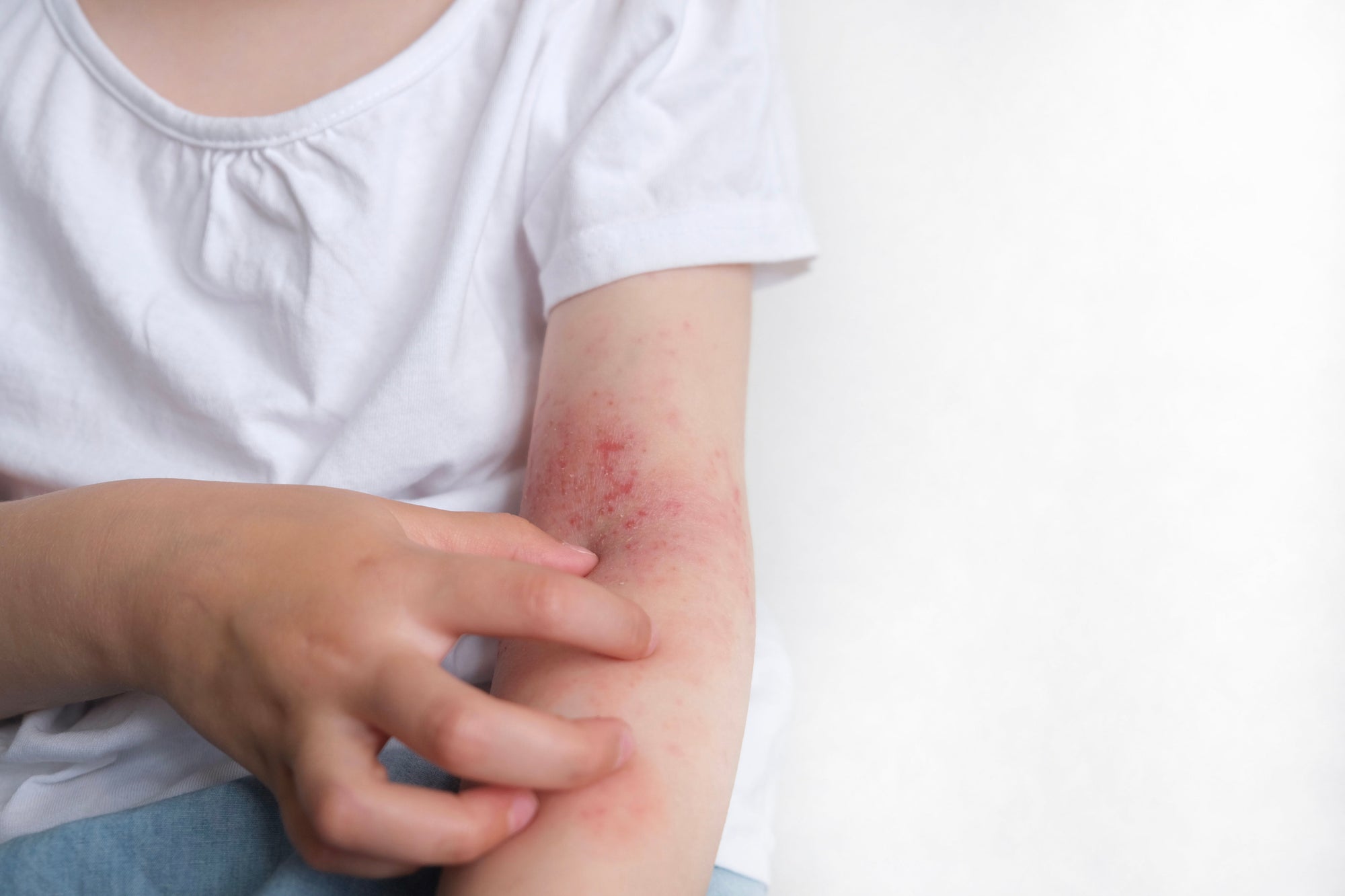 Can Stress Trigger Eczema? Understanding the Connection Between Stress and Skin Flare-Ups