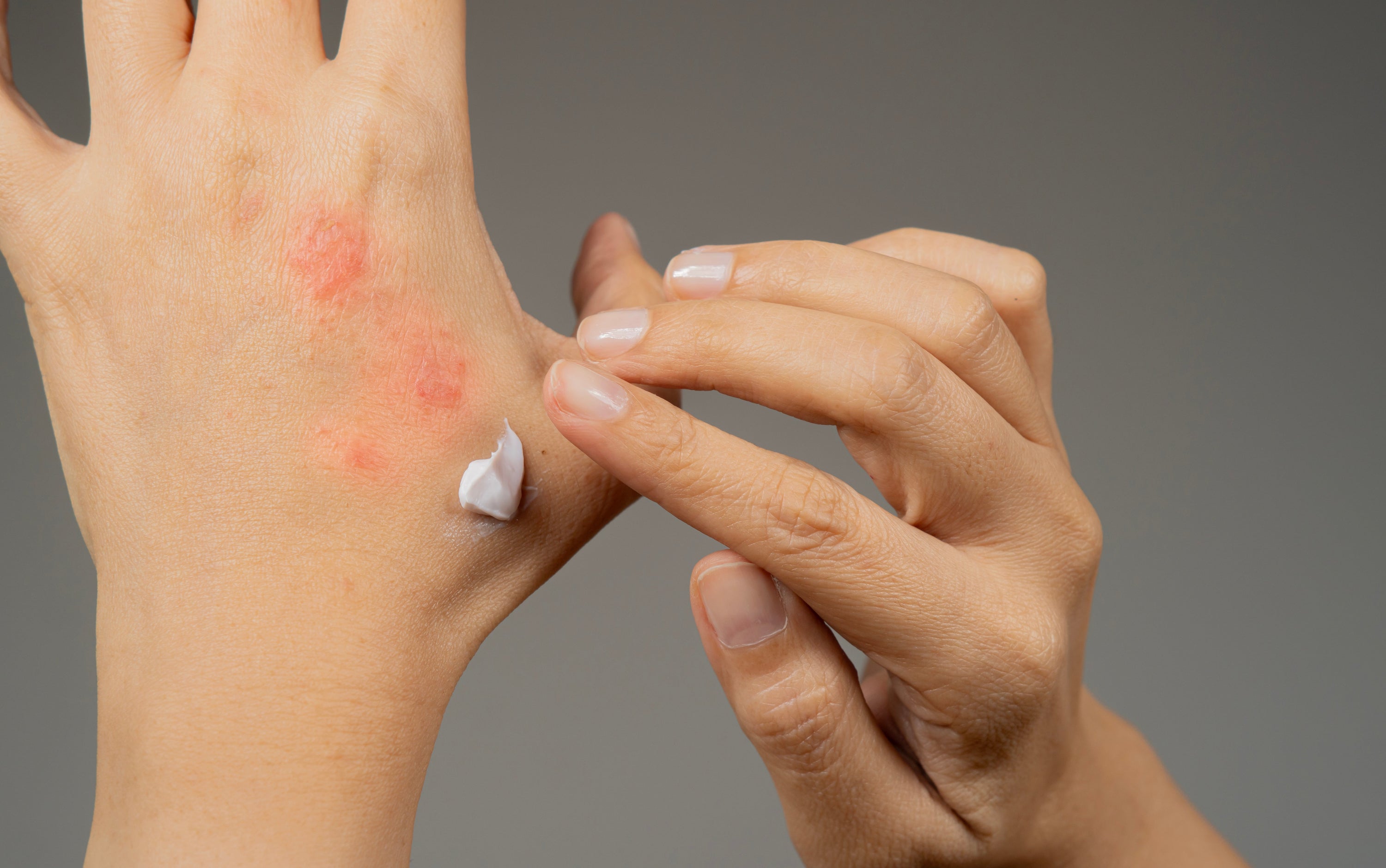 Eczema Care Guide: How to Take Care of Your Skin and Build the Right Routine