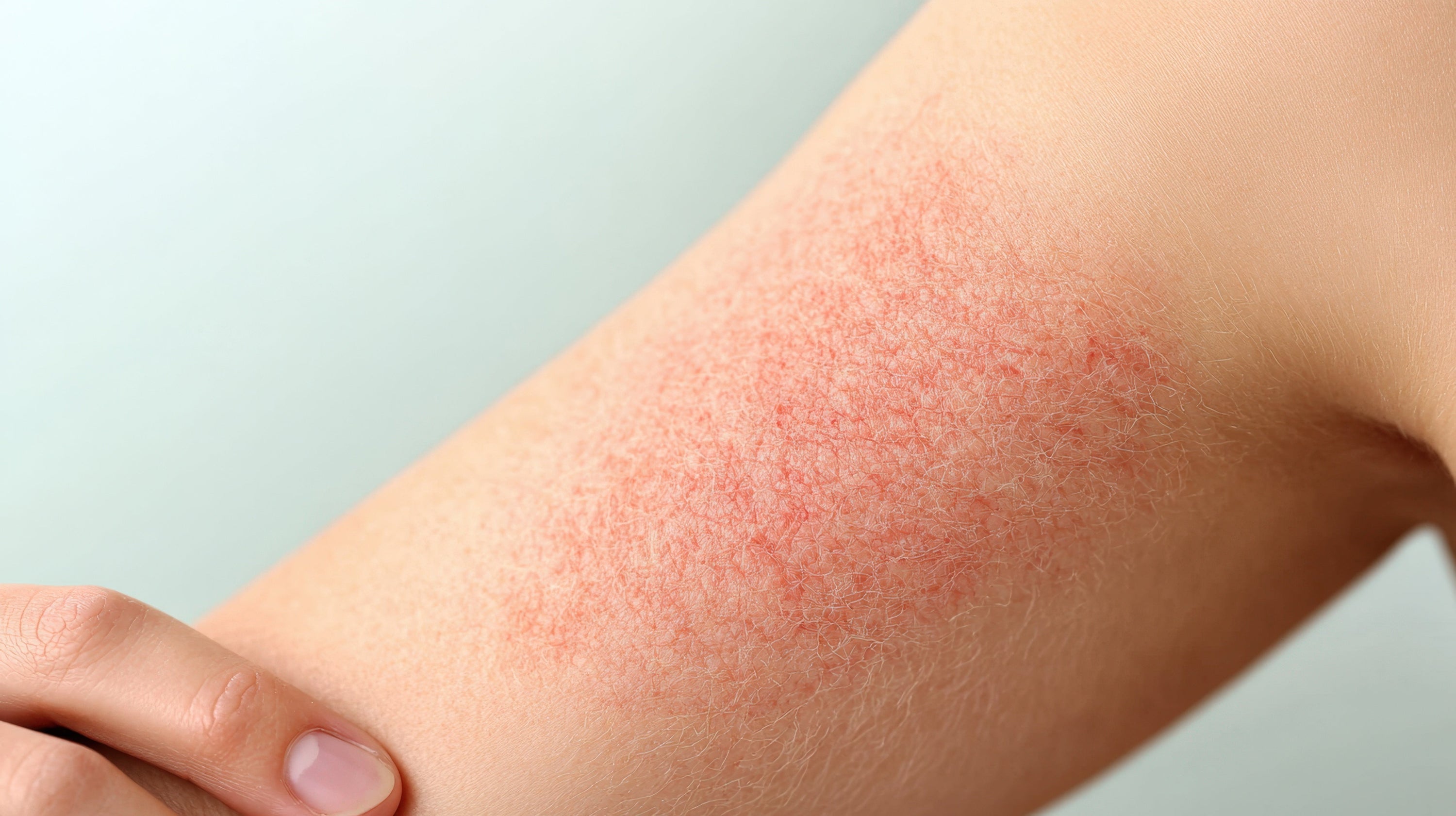 Can Eczema Be Seasonal? Why Your Skin Flares Up with the Weather